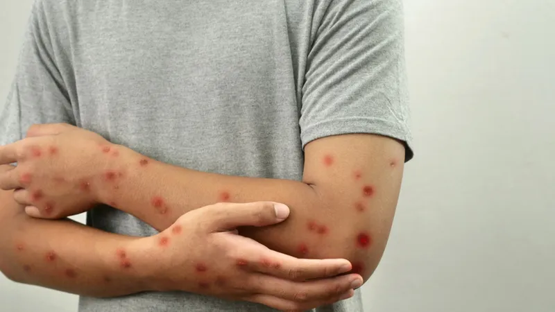 Maymun Çiçeği Alarmı! Türkiye'de Vaka Var mı? Aşı Şart mı?