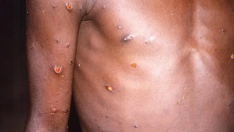 Kongo'da Korkunç Salgın! 9 Bin Mpox Vakası, Ölümcül Tehlike Büyüyor!